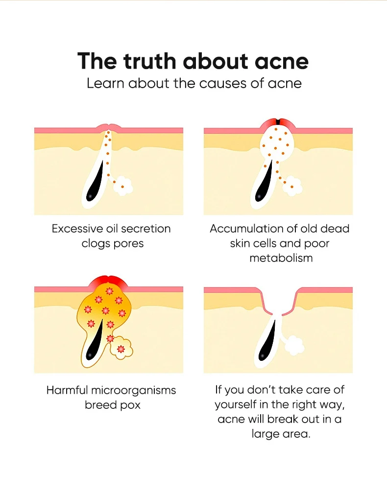 salicylic acne essence gel spu765871426565 desc 2