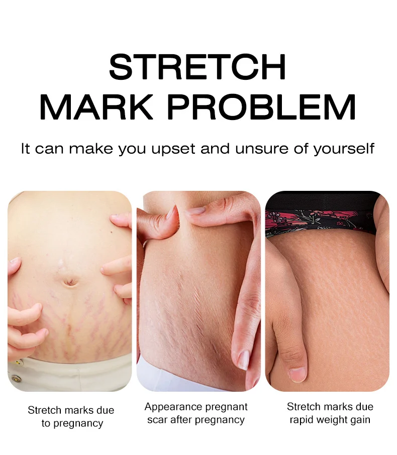 MOIKA Deep Mild Repair Stretch Mark Cream for Pregnancy & Postpartum 2 stretch mark repair cream spu704286310208 desc 2