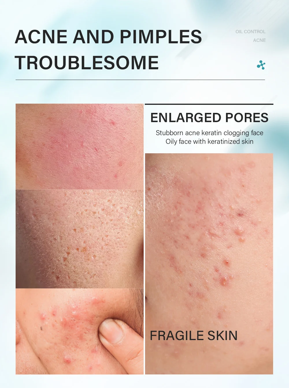 MOIKA Tea Tree Salicylic Acid Oil Control Acne Removal Skincare Set 2 tea tree salicylic acid acne skincare set spu780497845925 desc 2