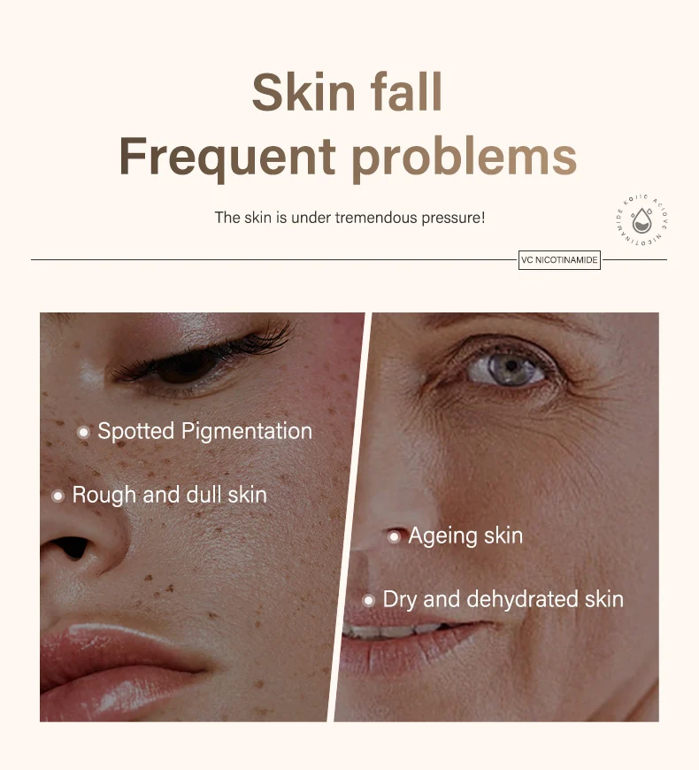 MOIKA VC Nicotinamide Kojic Acid Serum 30ml - Whitening Anti-Freckle Brightening Face Essence 2 vc kojic acid niacinamide serum spu733367399898 desc 2